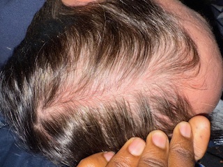 After: Smooth, Healthy, Dandruff-Free Hair