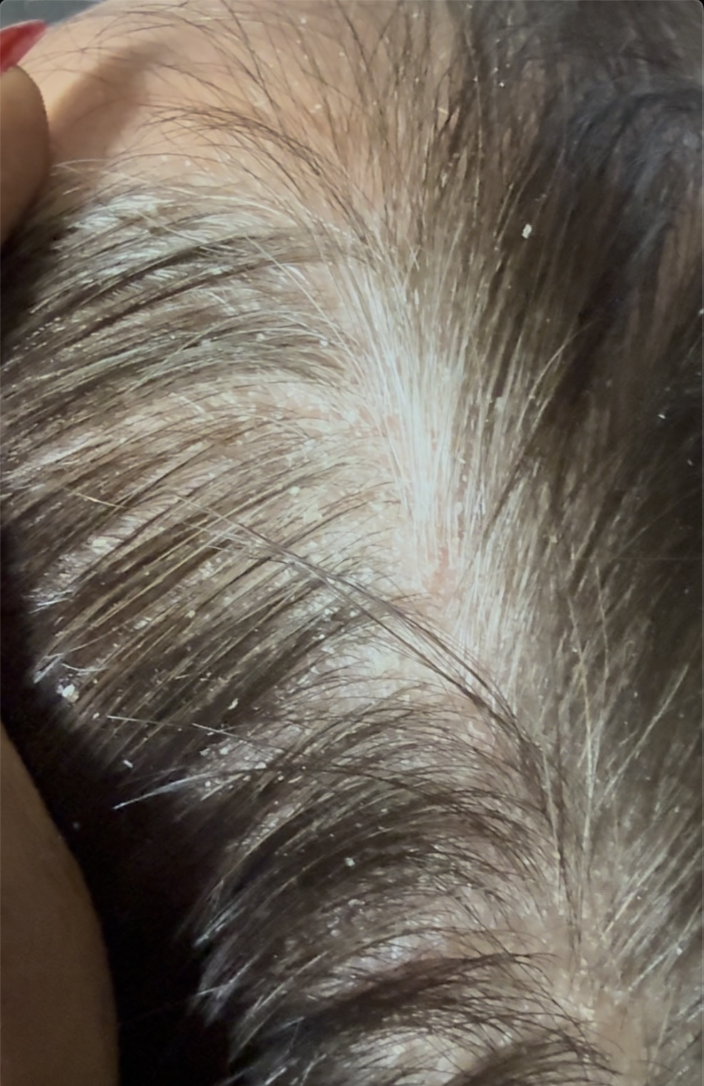 Before: Dry, Damaged Hair with Dandruff